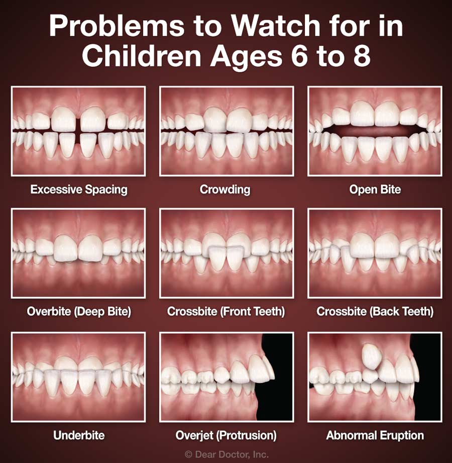 Old Bridge Braces