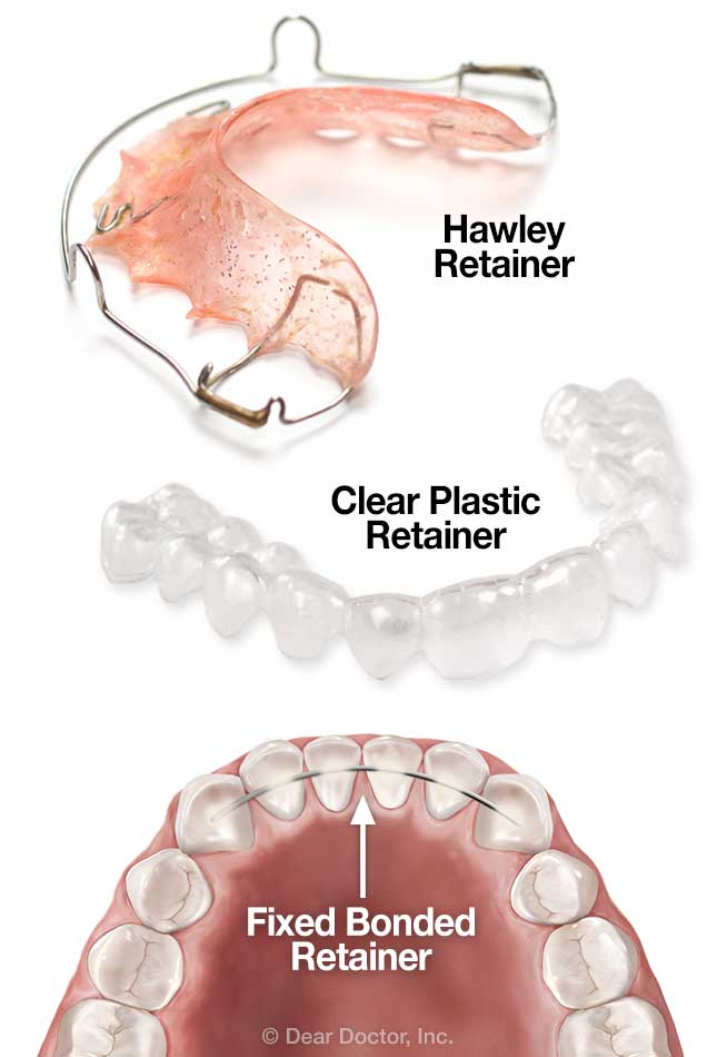 Types of Retainers After Braces: Essential Guide for Perfect Smile